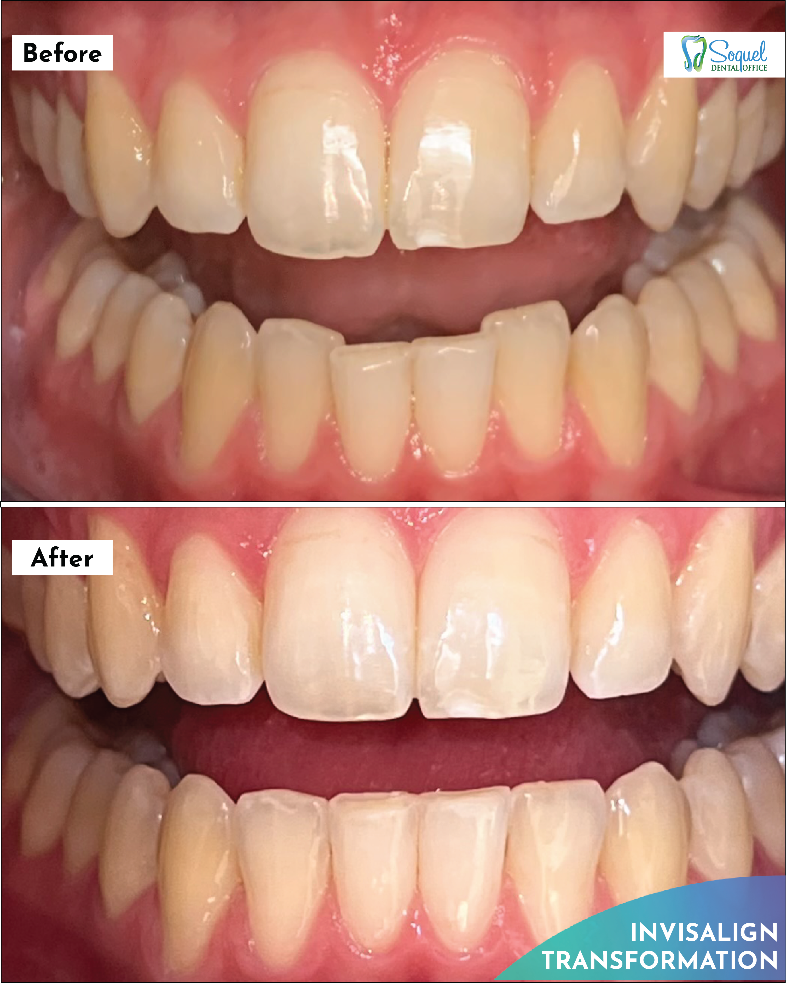 Before and after close-up of teeth straightened with Invisalign at Soquel Dental Office